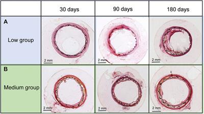 Effect of expanded <mark class="highlighted">polytetrafluoroethylene</mark> thickness on paclitaxel release and edge stenosis in stent graft